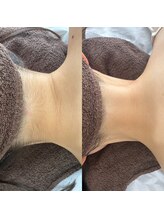 サロン ヴィラ(villa)/#脱毛#光脱毛#都度払い#うなじ