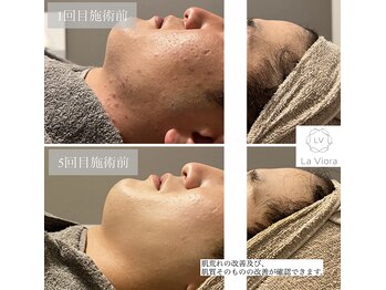 ラヴィオーラ 神戸三宮店(La Viora)/ダイヤモンドハーブピーリング