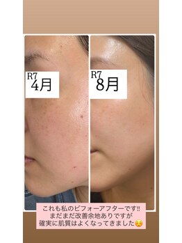 ミュベル(Myubelle)/肌質が変われば人生変わる◎