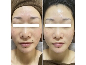 ナオフクオカ ヒーリングフォースエヌ(NaoFukuoka/healingforceN)/肌活力を上げ美しくなりましょう