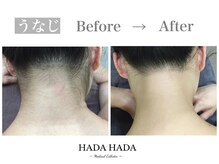 ハダハダ(HADA HADA Medical Esthetic)/うなじ脱毛で後ろ姿もキレイに♪