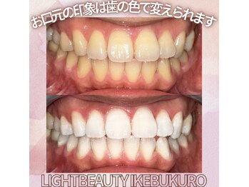 ライトビューティー 池袋店(LightBeauty)/症例写真