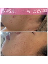 ミエル(miel)/長年悩んだ敏感肌ニキビケア