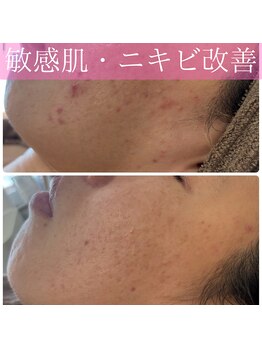 ミエル(miel)/長年悩んだ敏感肌ニキビケア