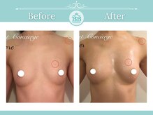 美人バスト大阪店/バストアップ◇症例◇ 