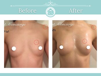 美人バスト大阪店/バストアップ◇症例◇