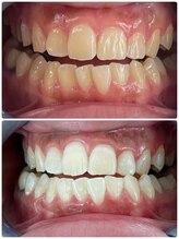 エクシア ホワイトニング 富山店/ビフォーアフター写真☆