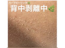 モカ 天王寺店(MOKA)/背中　ハーブピーリング　くすみ