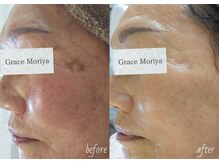 70代のお客様でもシミを排出！いくつになってもなりたい自分に♪