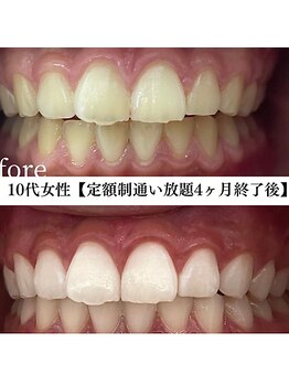 ホワイト 福岡博多店(WHITE)/ホワイトニングビフォーアフター