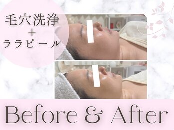 リライフ(ReLIFE)/韓国肌管理/毛穴洗浄+ララピール