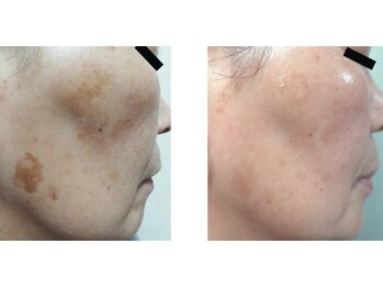 Nビューティー/セルフシミケアプログラム