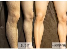 メンズアルファの雰囲気（【全身脱毛1回17,500円】ヒゲ・VIO含む全身まるごとツルツルに!）