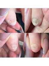 キュア(Cure.)/足の小指の形も美しく整う