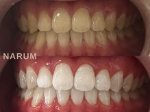 ナルムホワイトニング 代々木(NARUM whitening)