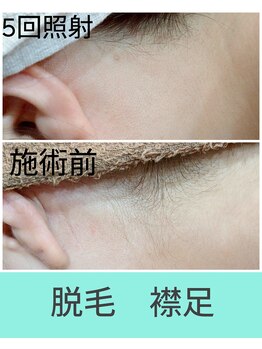 エミナル(EMINAL)/襟足脱毛の効果!脱毛/襟足/