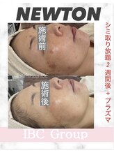 トータルサロンアイビーシー(トータルサロンIBC)/NEWTON シミケア