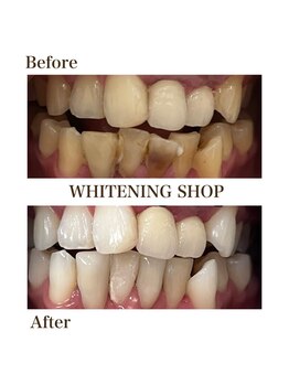 ホワイトニングショップ 徳島藍住店/Before After美白ホワイトニング