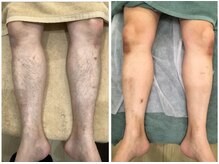 叶(Kanau)/脚脱毛