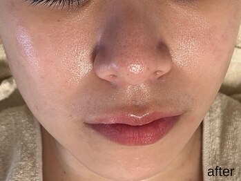 サロン ド エメ(salon de aimer)/【After】赤み改善、毛穴縮小