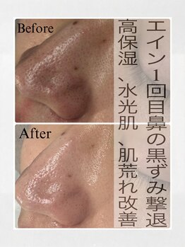 ジョルフ サロン オリジナル(JOLF salon original)/毛穴黒ずみ撃退