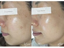 レーザー後の炎症後色素沈着によるシミもキレイに改善♪