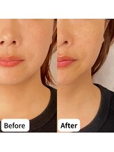 ヒカリエステ 六本木(HIKARI ESTHE)/切らない小顔リフト