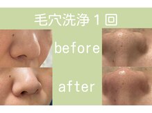 毛穴の頑固な黒ずみ角栓撃退！毛穴×光で更に毛穴レス水光肌へ