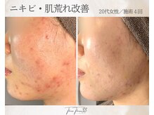 スリースリー 恵比寿(THREE THREE)/ニキビ・肌荒れケア
