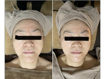 シャイニング(shining)/☆フェイシャル