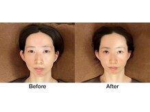 こじま 富雄団地接骨院/ヒト幹細胞美容鍼