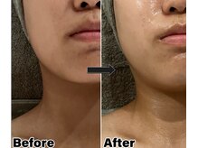 プラリセル(PLa:Recell)/お肌キレイコース¥4980