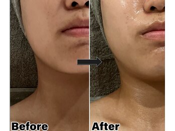 プラリセル(PLa:Recell)/お肌キレイコース¥4980