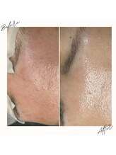 イチロクイチハチ(1618)/赤み肌にはまず鎮静