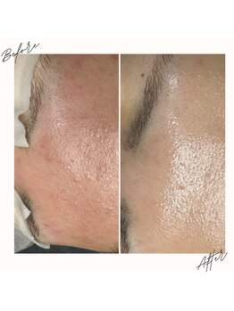 イチロクイチハチ(1618)/赤み肌にはまず鎮静