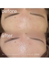 ルルラ リコ(lulula rico)/症例写真/ハーブピーリング