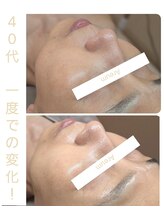 アルム(Areum)/肌育ラミネーションピール♪