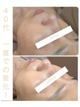 アルム(Areum)/肌育ラミネーションピール♪