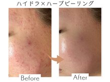 ベル(Belle)/ハイドラ＋ハーブピーリング