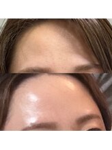 チル(Chill)/【松ヤニパック後】艶肌素肌へ