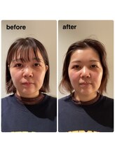 アネラ 本町(ANERA)/小顔矯正&毛穴洗浄BeforeAfter