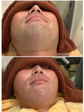 叶(Kanau)/髭脱毛