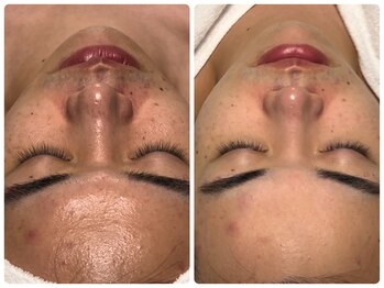 ベルドア(Bell Door)/ニキビ/皮脂ケア