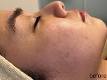 サロン ド エメ(salon de aimer)/【Before】赤み、開き毛穴に！