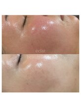 エクラ(eclat)/マーメイドセルトリートメント