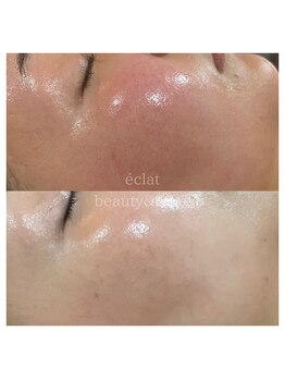 エクラ(eclat)/マーメイドセルトリートメント