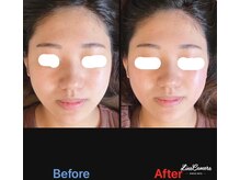 美容矯正サロン レレポノ(LELEPONO)/小顔施術