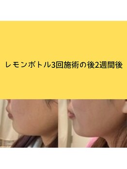 フェリス(feliz)/レモンボトル[小顔/美白/白石区]