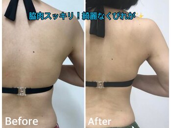 セラビシャン/before→after【背中、二の腕】