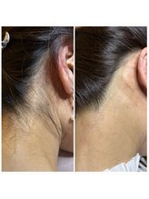 スキンラボ カホクカイ(KaHokuKai)/１回/4週　　4回目